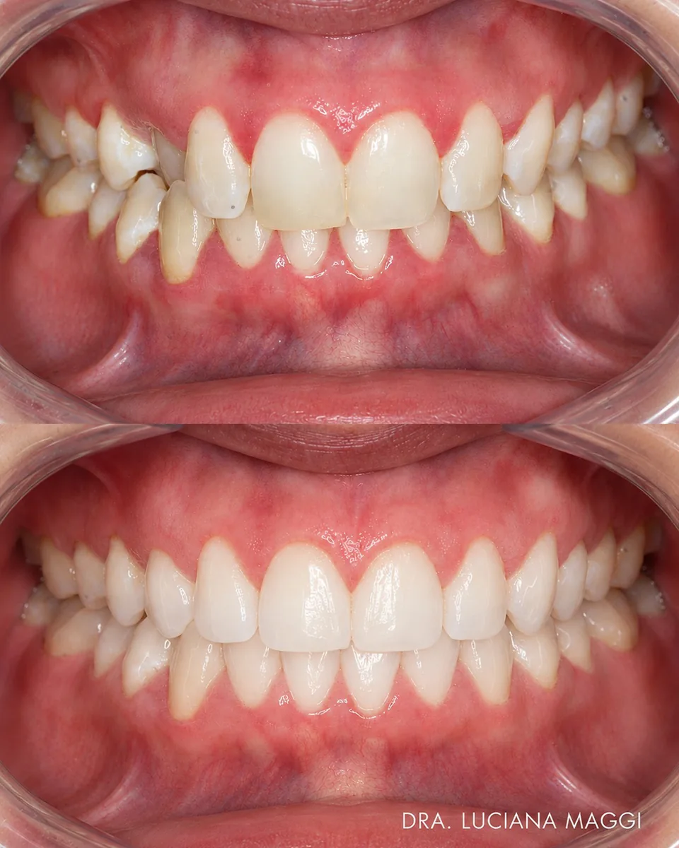 Antes e depois de tratamento ortodôntico — caso 2