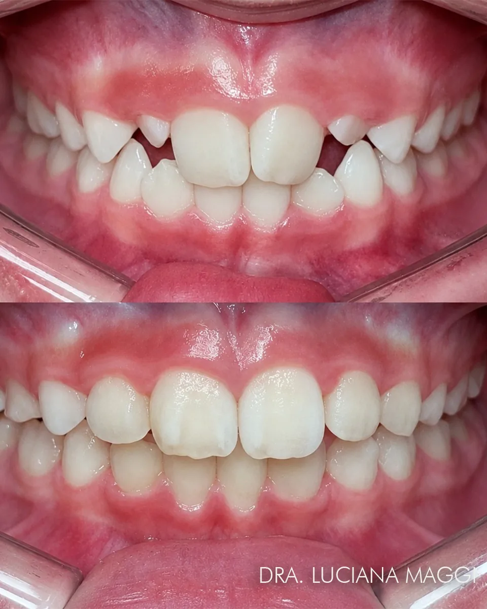 Antes e depois de tratamento ortodôntico — caso 4
